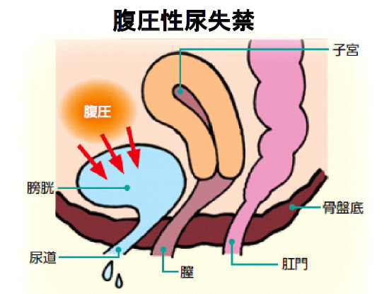 腹圧性尿失禁